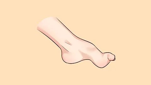 链球菌感染综合症是风湿热吗