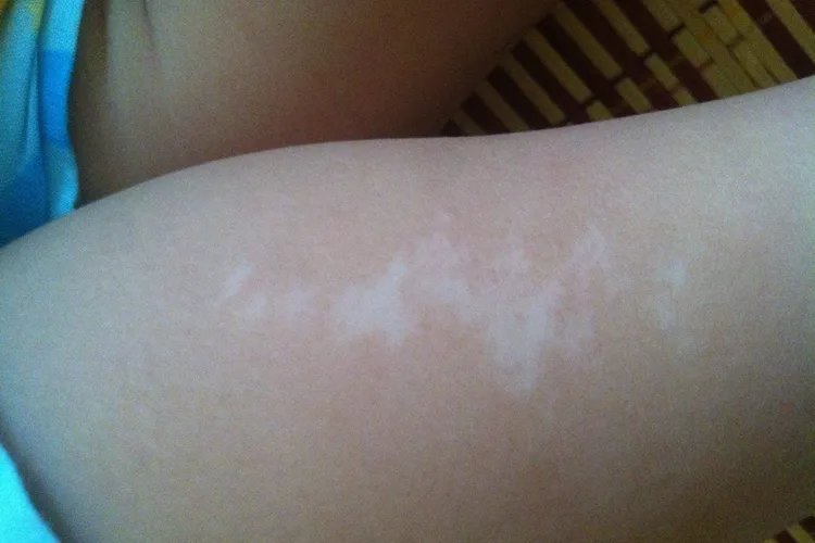 幼儿白斑早期图片大全