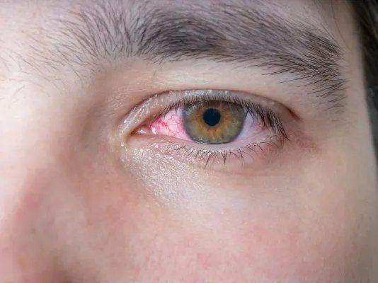 眼睛紫色淤青多久好