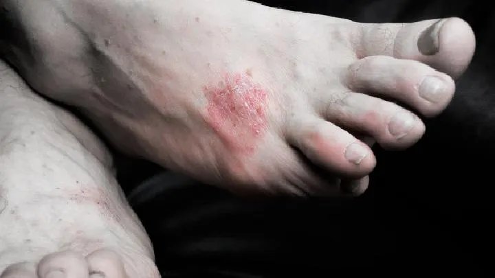 扁平苔藓有哪些常见的治疗方法