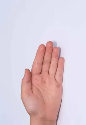 夏天手上起小水泡是什么原因导致的