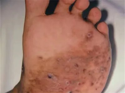 足菌肿症状图片