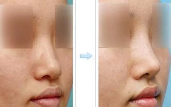 鼻翼整形术多少钱