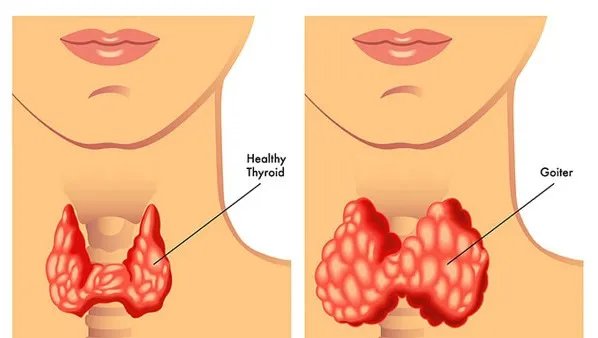 甲状腺激素偏高怎么办