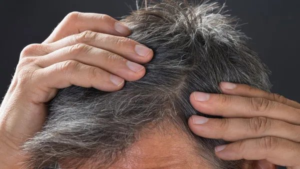 头发出油怎么办？