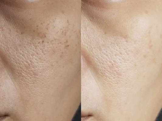 怎样去斑点比较好