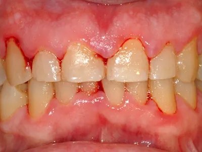 牙龈炎牙龈出血图片