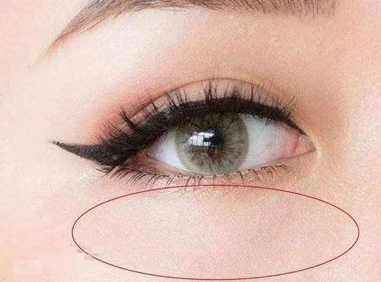 广州割双眼皮医院哪家好