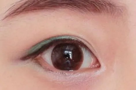 开内眼角手术的恢复期