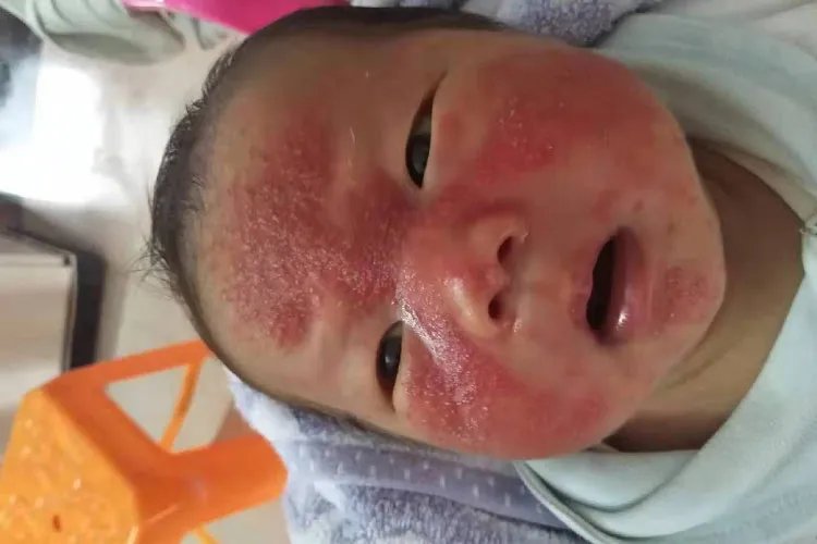 面部脂溢性皮炎症状图