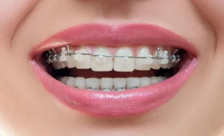 纯钛烤瓷牙价格多少