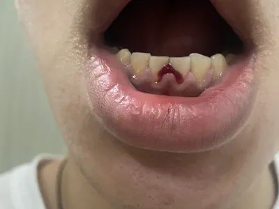 牙龈炎牙龈出血图片