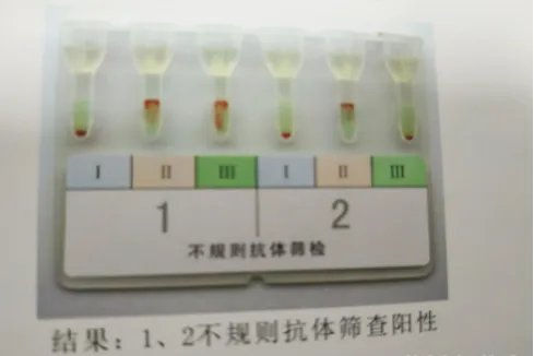 不规则抗体筛查结果判断图