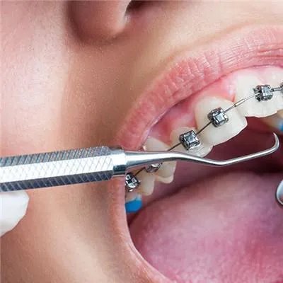 什么可以美白牙齿