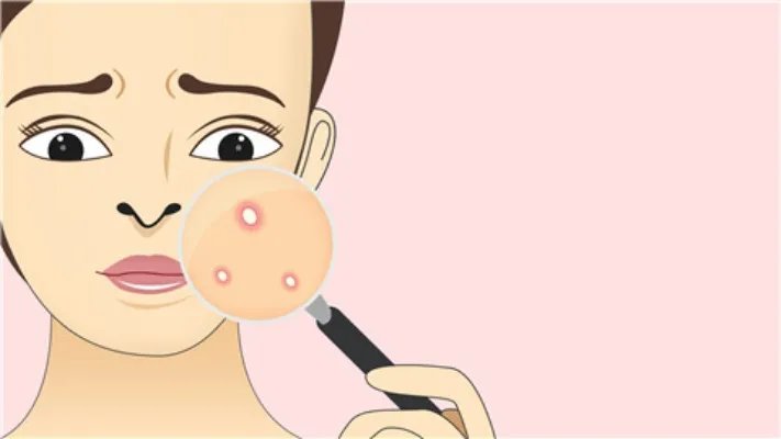 鼻子上长痘痘的原因