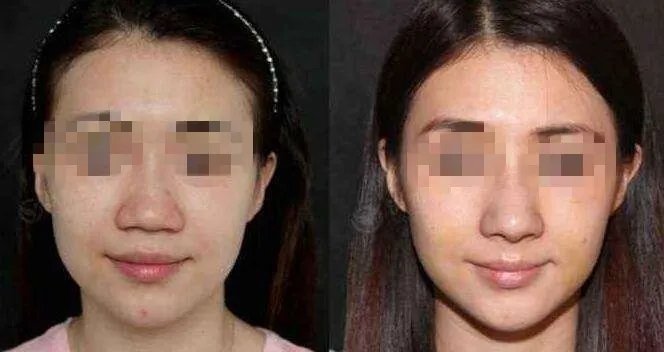 蒜头鼻整形图片对比