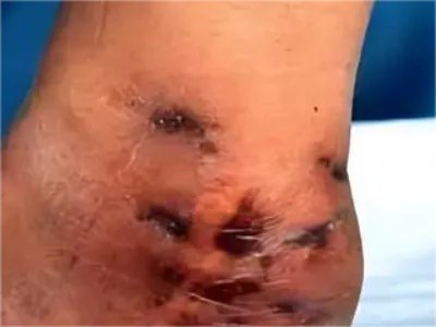 足菌肿症状图片