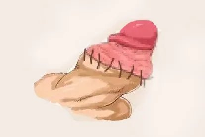 小孩刚割完包皮图片