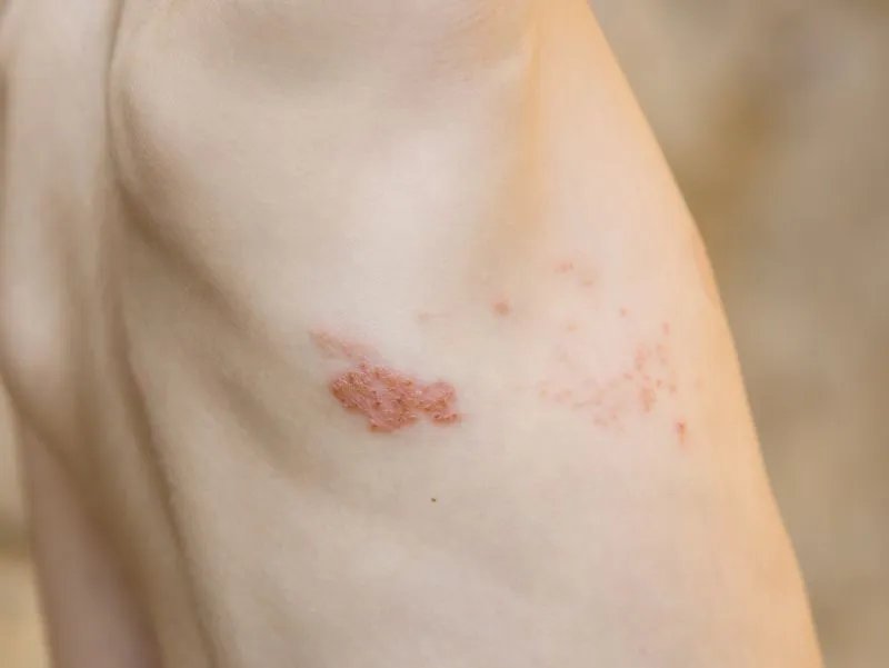 疱疹的治疗方法