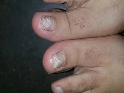 远端侧位甲下型甲真菌病脚趾甲缩小图片