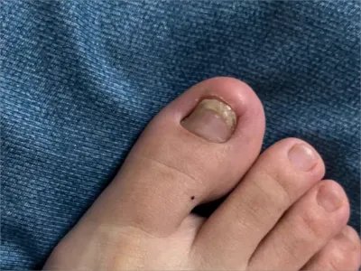 远端侧位甲下型甲真菌病脚趾甲缩小图片