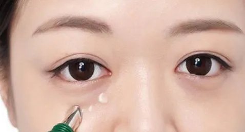 广州割双眼皮医院哪家好