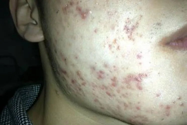 怎么判断自己痘痘的类型图片