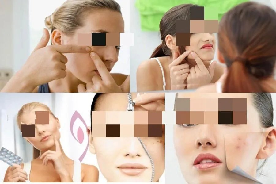 揉自己的痘痘的方法图