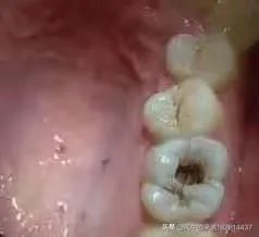 最后一颗大牙坏了一个洞，现在牙龈好痛，该怎么办呢？