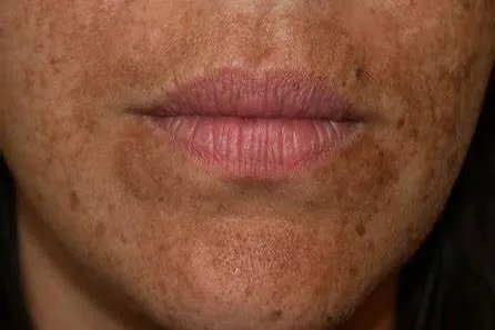 黄雀斑和黄褐斑图片