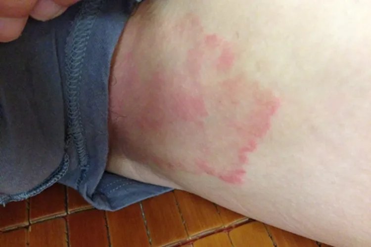 大腿内侧长了好多红色点点图片