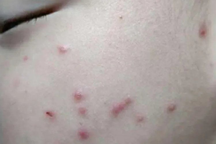 小儿痒疹症状图片