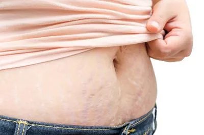 产后妊娠纹怎么淡化 淡化妊娠纹妙招都在这里