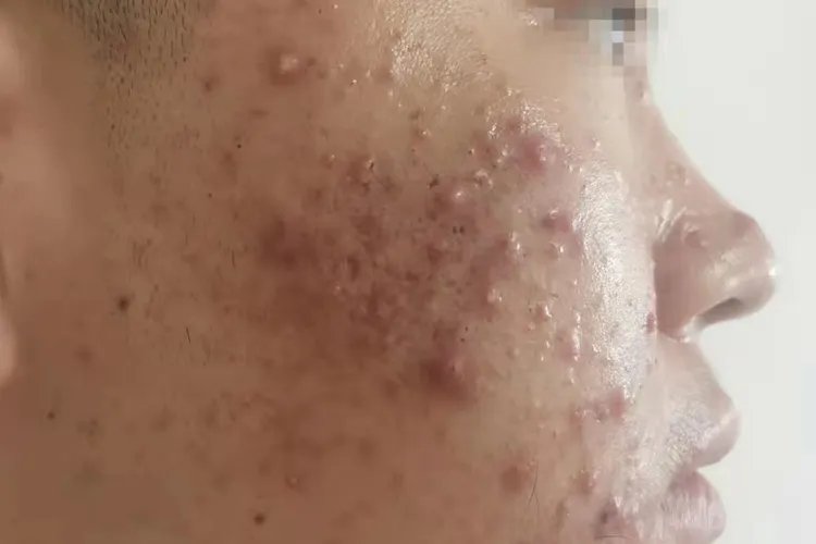 怎么判断自己痘痘的类型图片