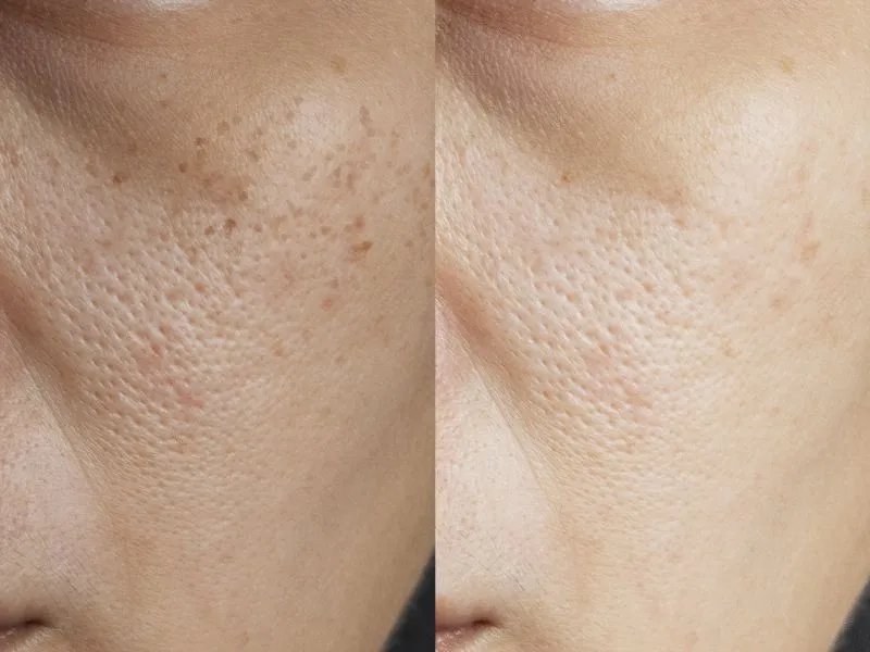 激光去斑有用吗