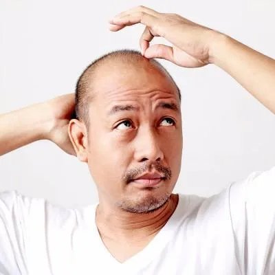 脱发原因及治疗