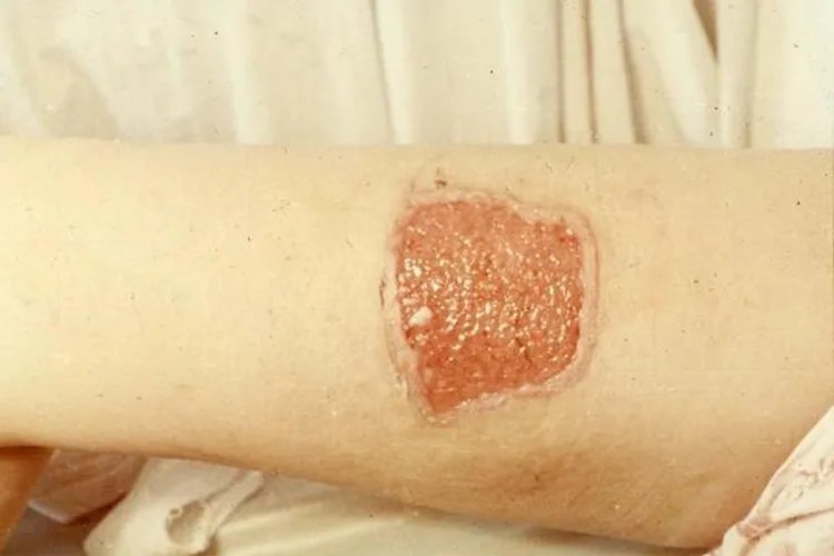 伤口肉芽增生图片