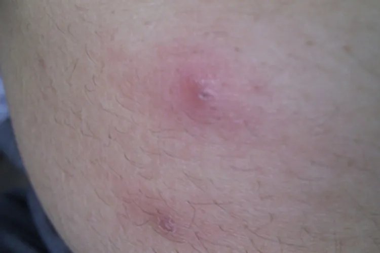 蜱咬伤症状图片