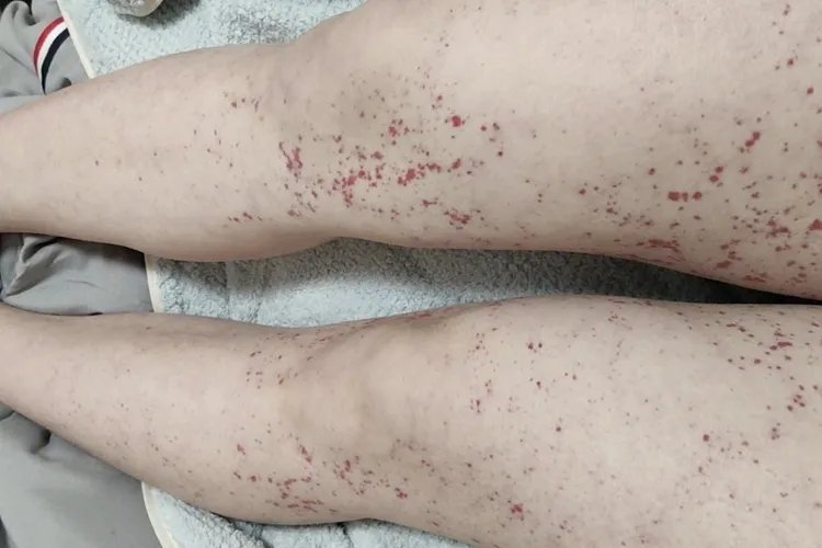 大腿内侧长了好多红色点点图片