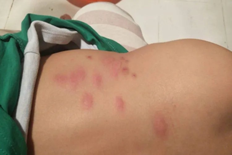 小儿痒疹症状图片