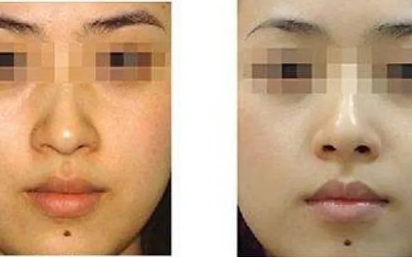 北京光子嫩肤需要多少钱