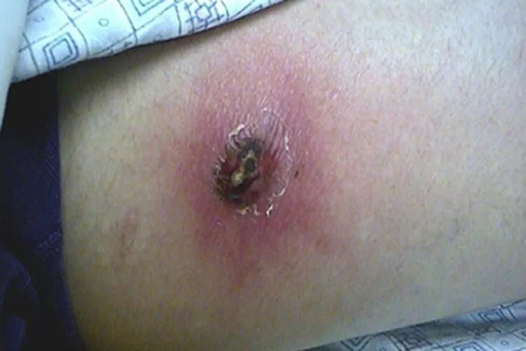 蜱咬伤症状图片