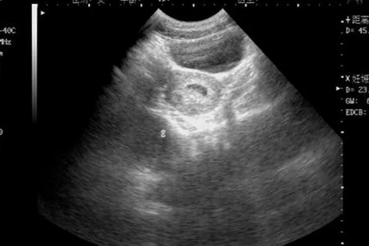 怀孕30天左右B超图片