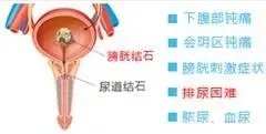南京龙蟠结石医院专家解析：膀胱结石的症状