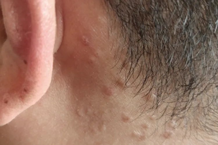 小儿痒疹症状图片