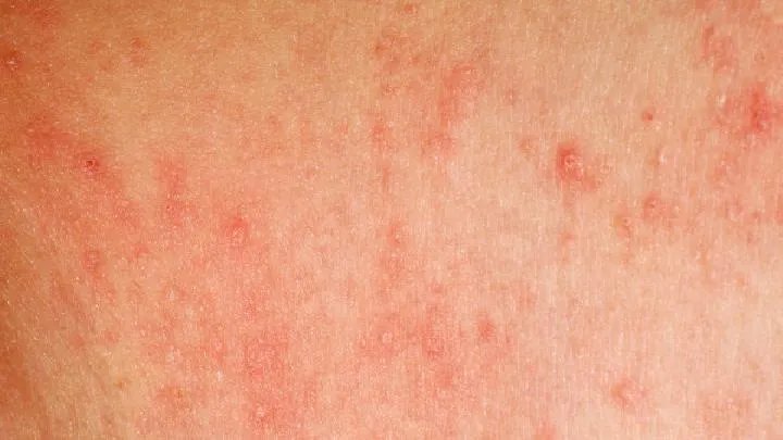 黄褐斑中医怎样治疗