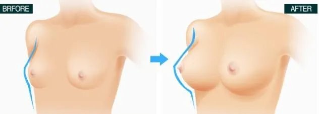 做隆胸术需要多少费用