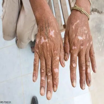 得了白癜风该如何治疗