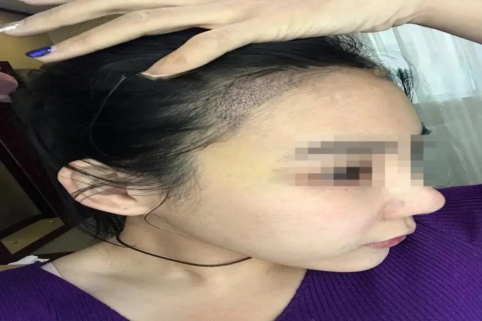 植发美人尖效果图