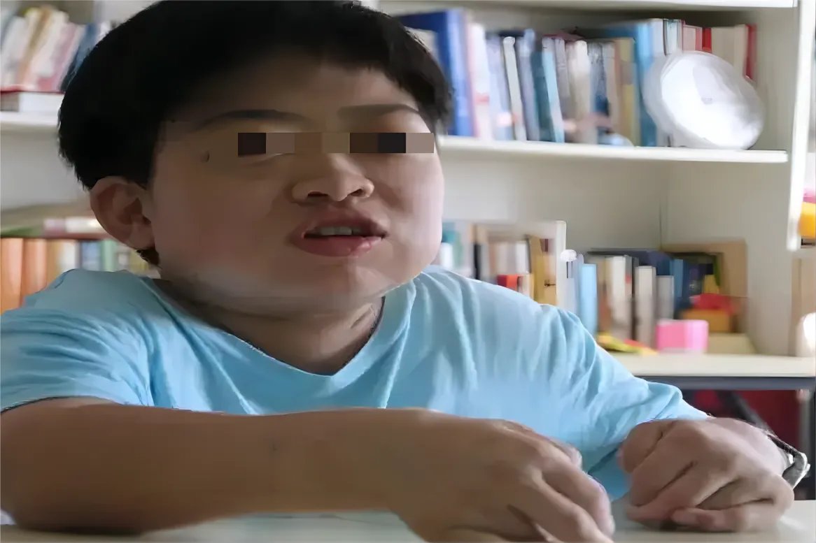 粘脂质贮积症面容照片